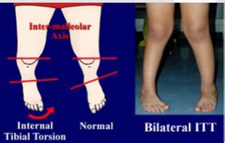 tibial torsion special test|femoral anteversion and tibial torsion.